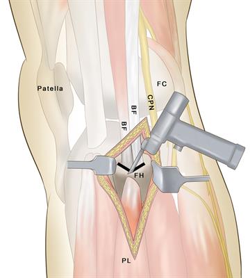 Partial Fibular Head Osteotomy is an Alternative Option in Treatment of Posterolateral Tibial Plateau Fractures: A Retrospective Analysis